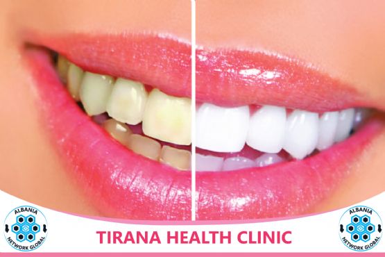 Zbardhim Profesional i Dhëmbeve Nga Dentiste Denisa Kola te TIRANA HEALT...