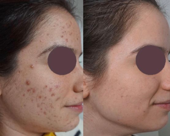 Klinika Dermatologjike Venus, Laser fraxional jo albativ 1450 nm per trajtimin e akneve, laser per shenjat e akneve, laser per rrudhat fine nga Dr Brunilda Bardhi